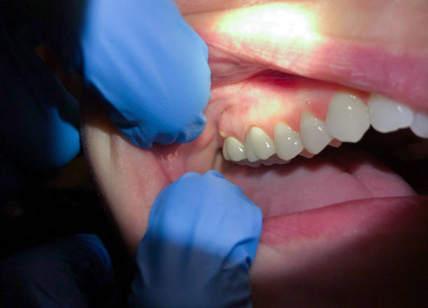 Best Emergency Care for Gum Disease in Chenoa, IL
